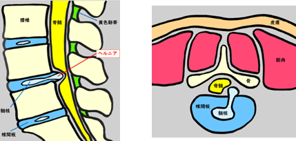 腰椎椎間板ヘルニア