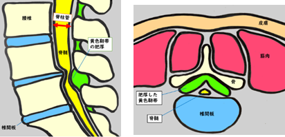 腰部脊柱管狭窄症