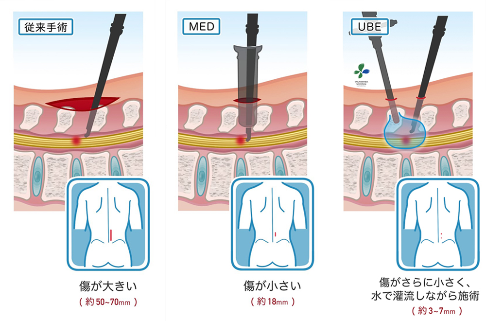 従来手術MEDUBE